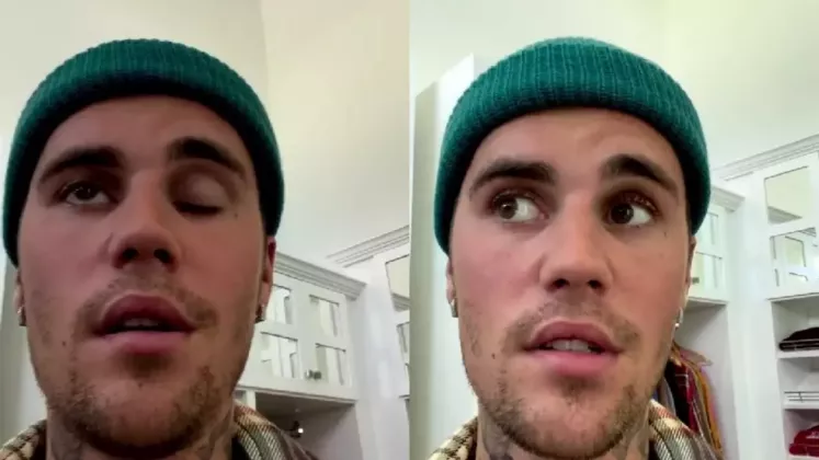 justin-bieber-paralizie-faciala-scaled