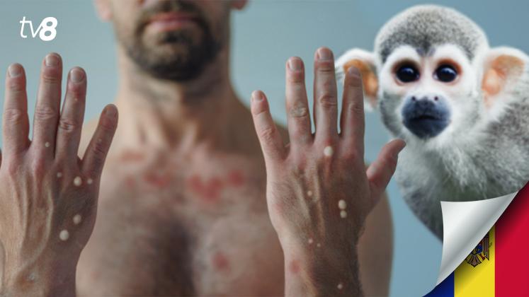 Monkeypox