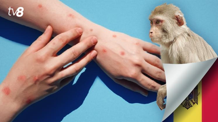 Monkeypox