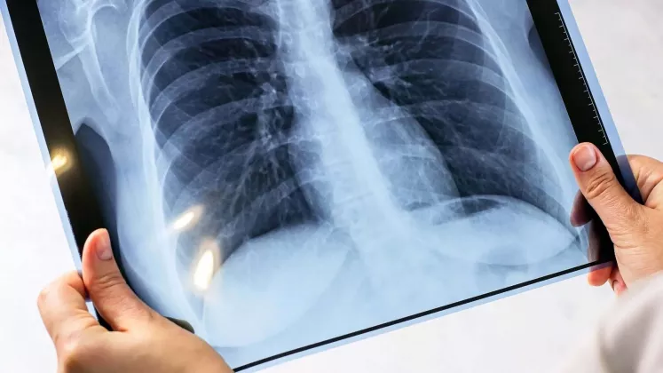 tuberculoză