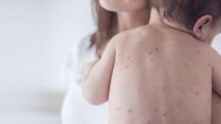 Copiii nevaccinați împotriva rujeolei nu vor fi admiși în școli și grădinițe? Anunțul Primăriei Chișinău
